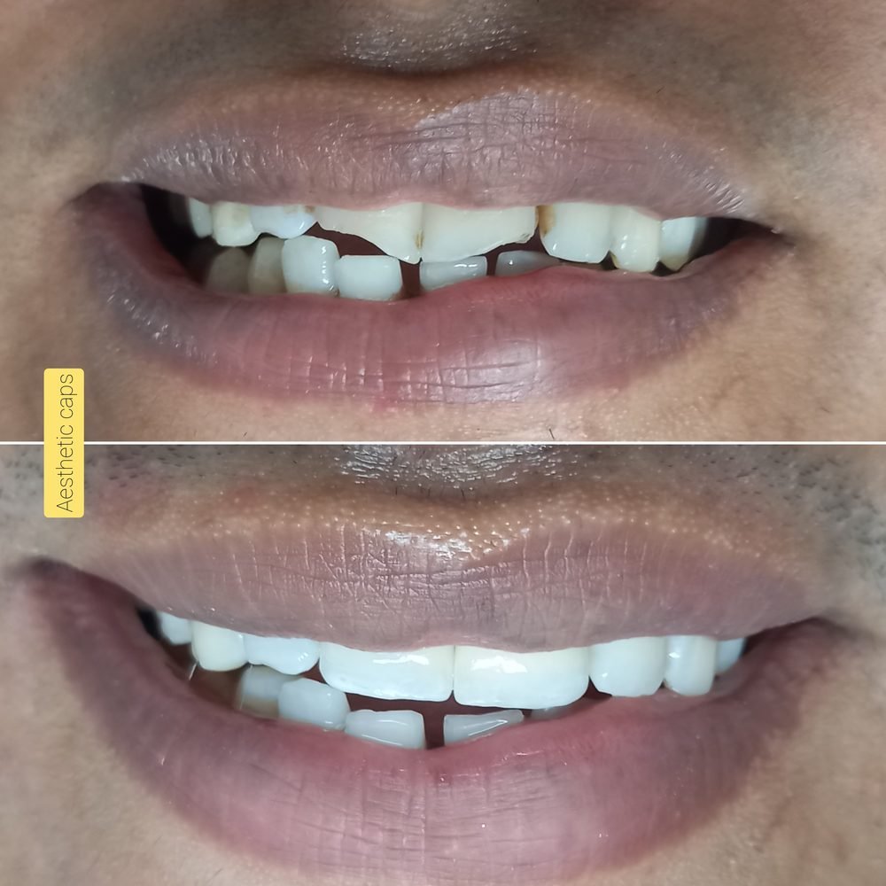 Aesthetic dental caps case