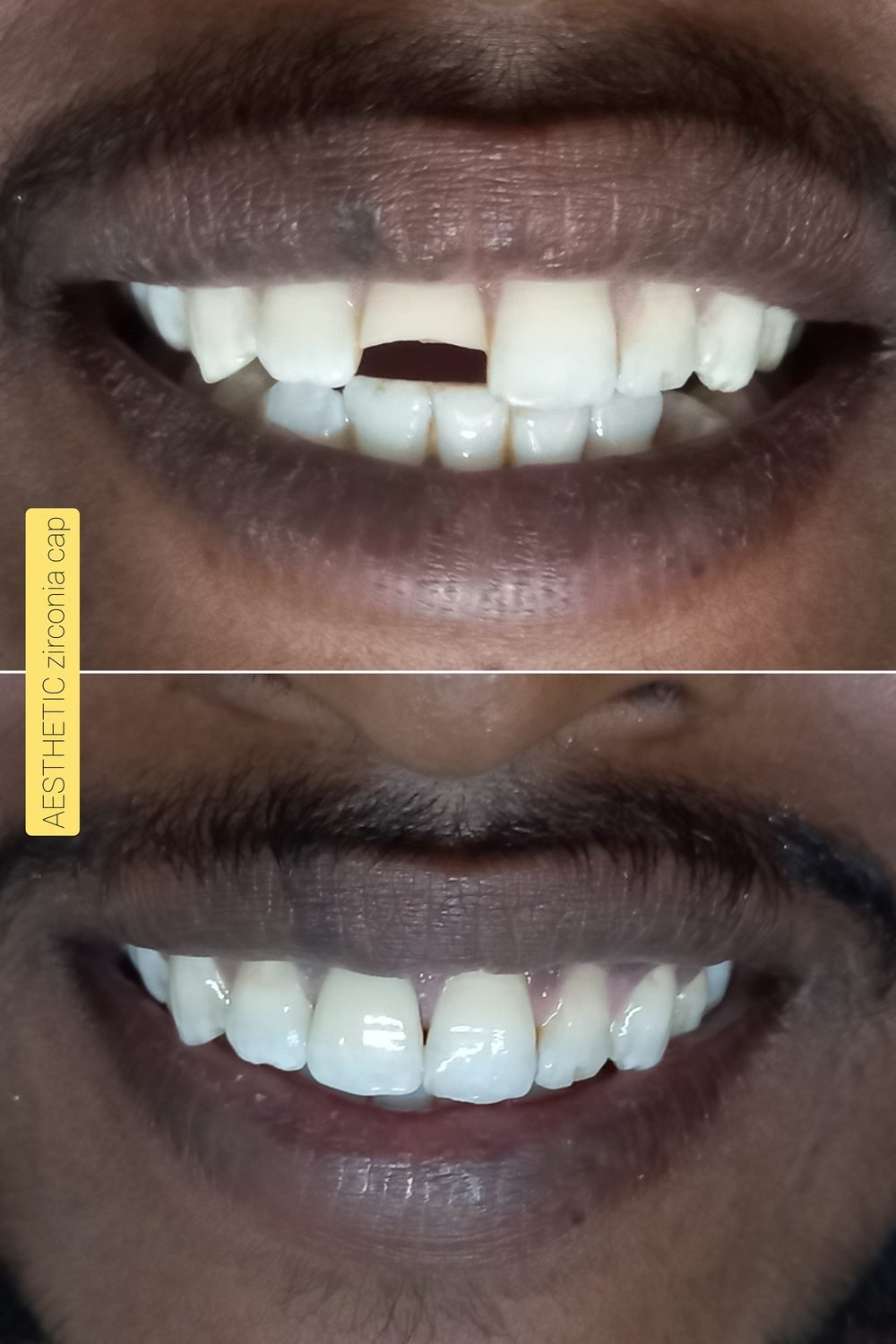 Zirconia cap case