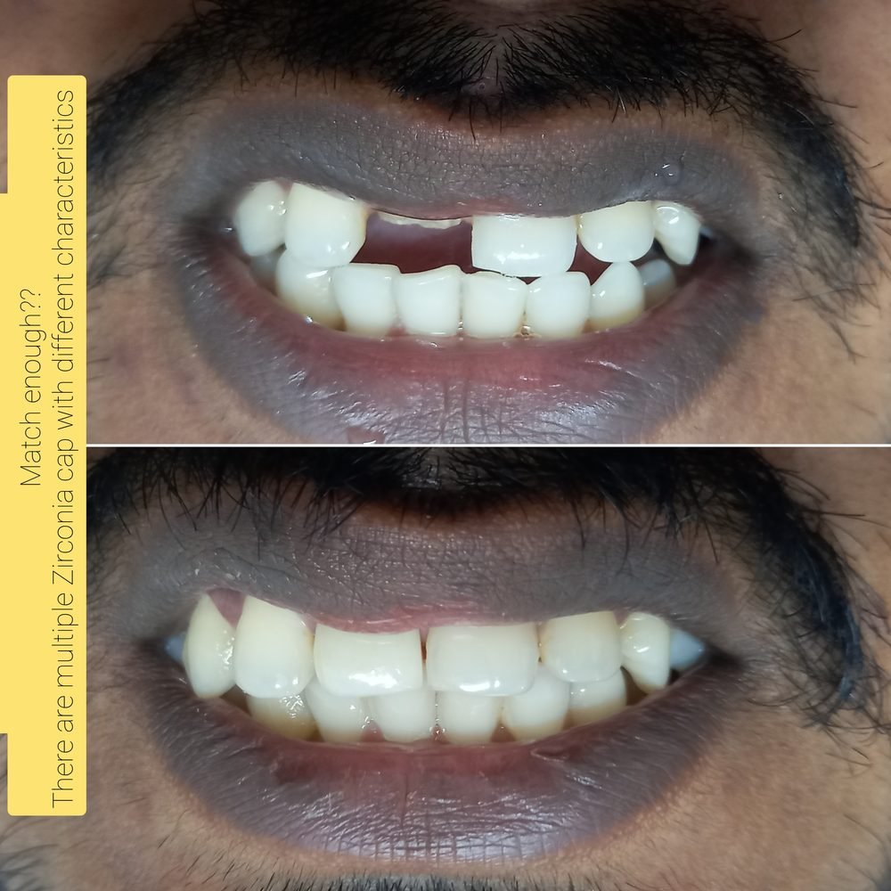 Zirconia shade match case